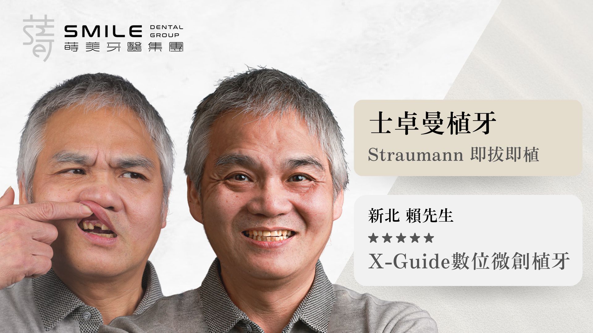 蒔美straumann植牙案例