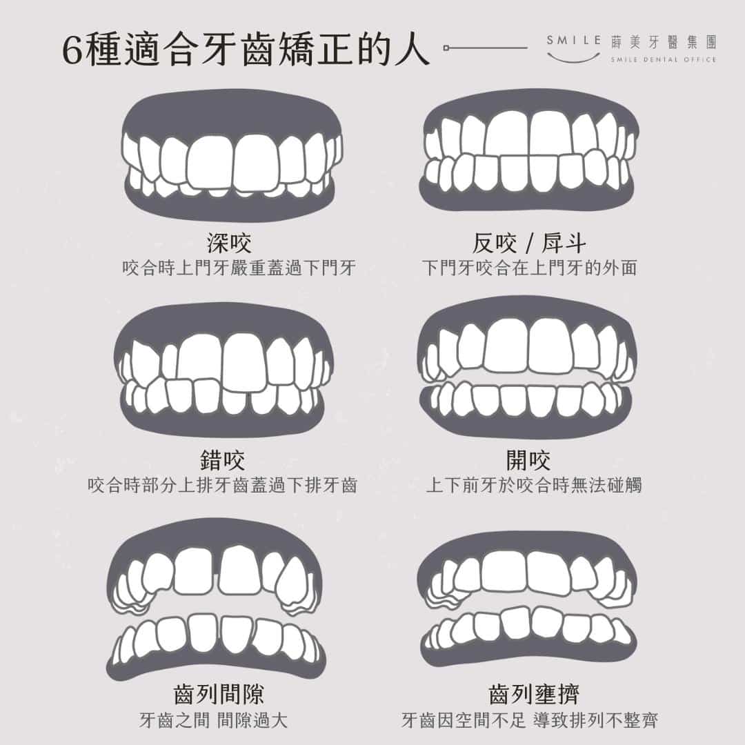 深 咬 矯正 方式