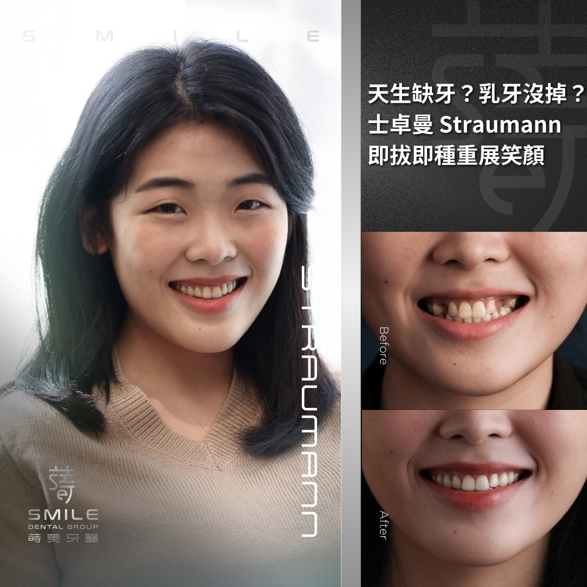 Straumann植牙案例-台北植牙推薦-蒔美牙醫-3