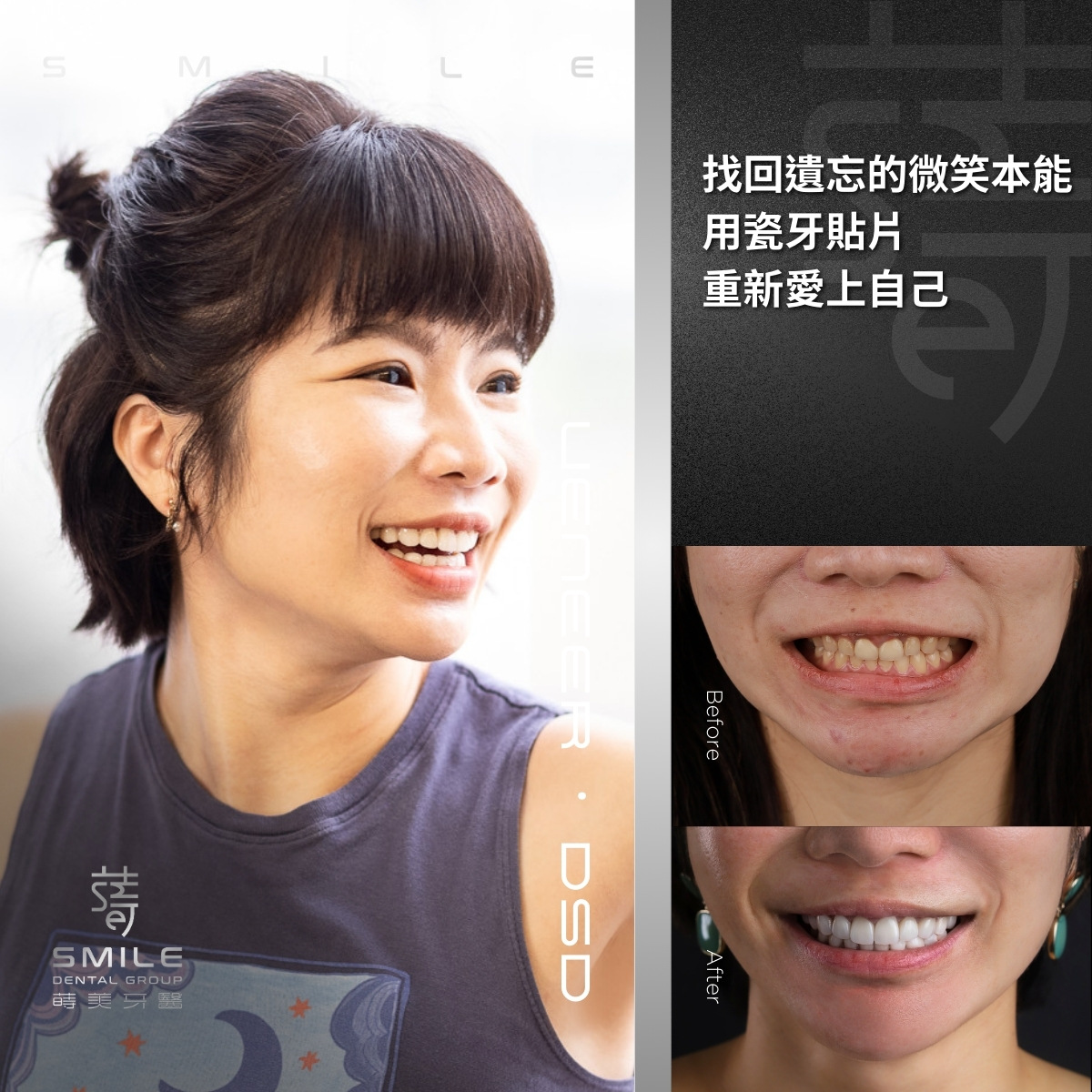 全瓷貼片案例-台北陶瓷貼片推薦-蒔美牙醫-10