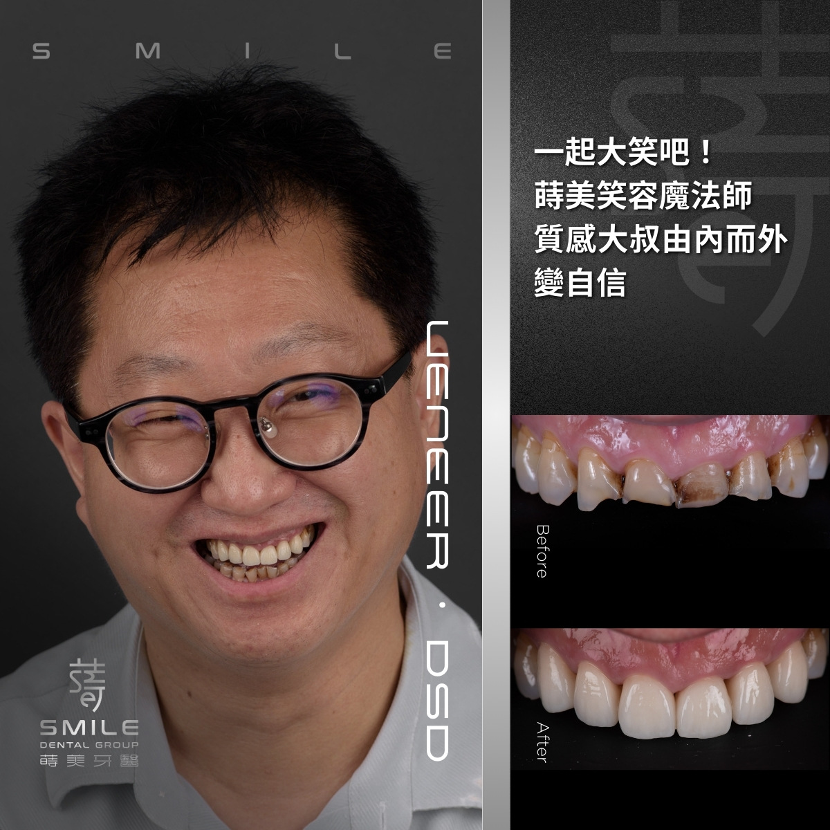 全瓷貼片案例-台北陶瓷貼片推薦-蒔美牙醫-12