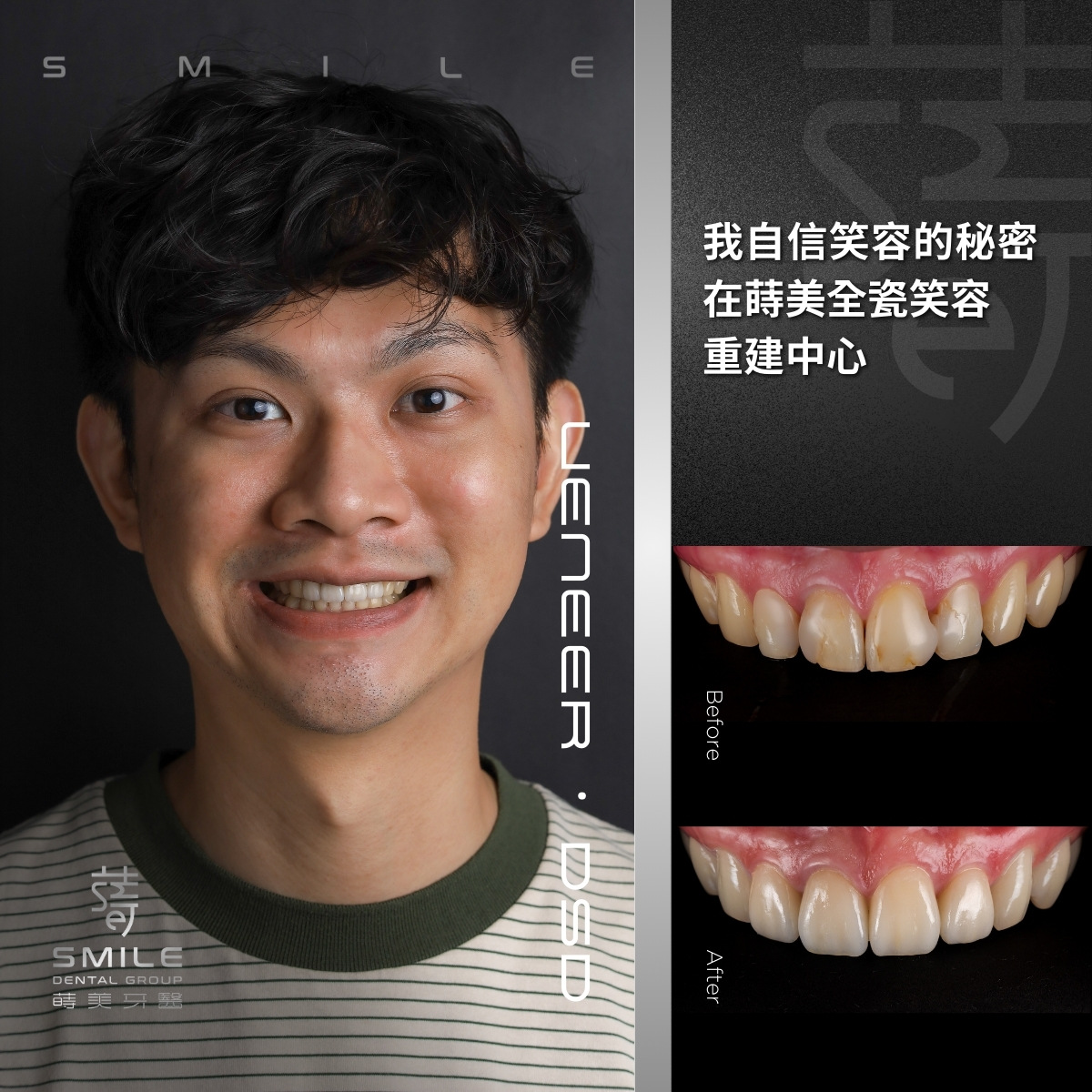 全瓷貼片案例-台北陶瓷貼片推薦-蒔美牙醫-3