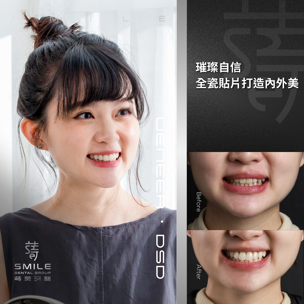 全瓷貼片案例-台北陶瓷貼片推薦-蒔美牙醫-4
