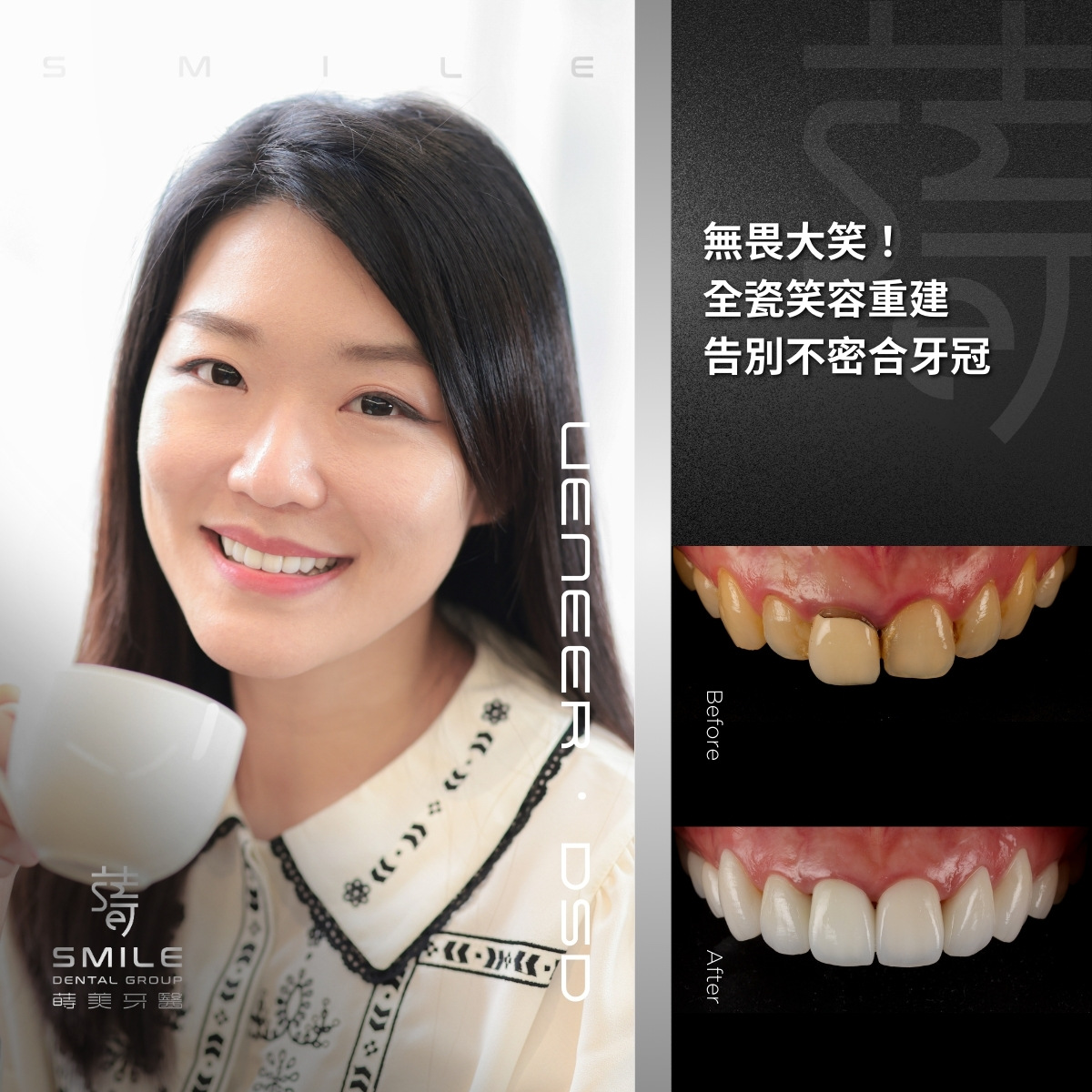 全瓷貼片案例-台北陶瓷貼片推薦-蒔美牙醫-5