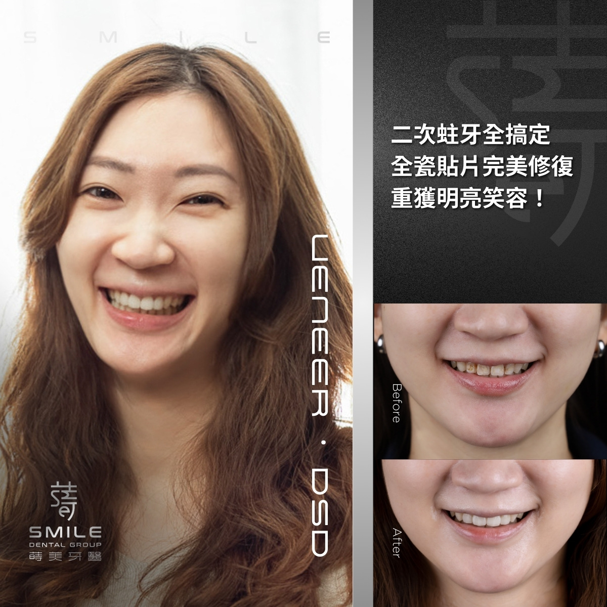 全瓷貼片案例-台北陶瓷貼片推薦-蒔美牙醫-6