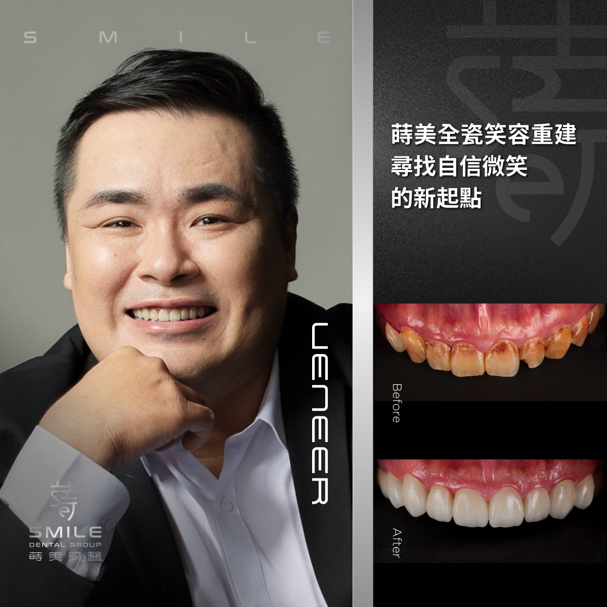 全瓷貼片案例-台北陶瓷貼片推薦-蒔美牙醫-2