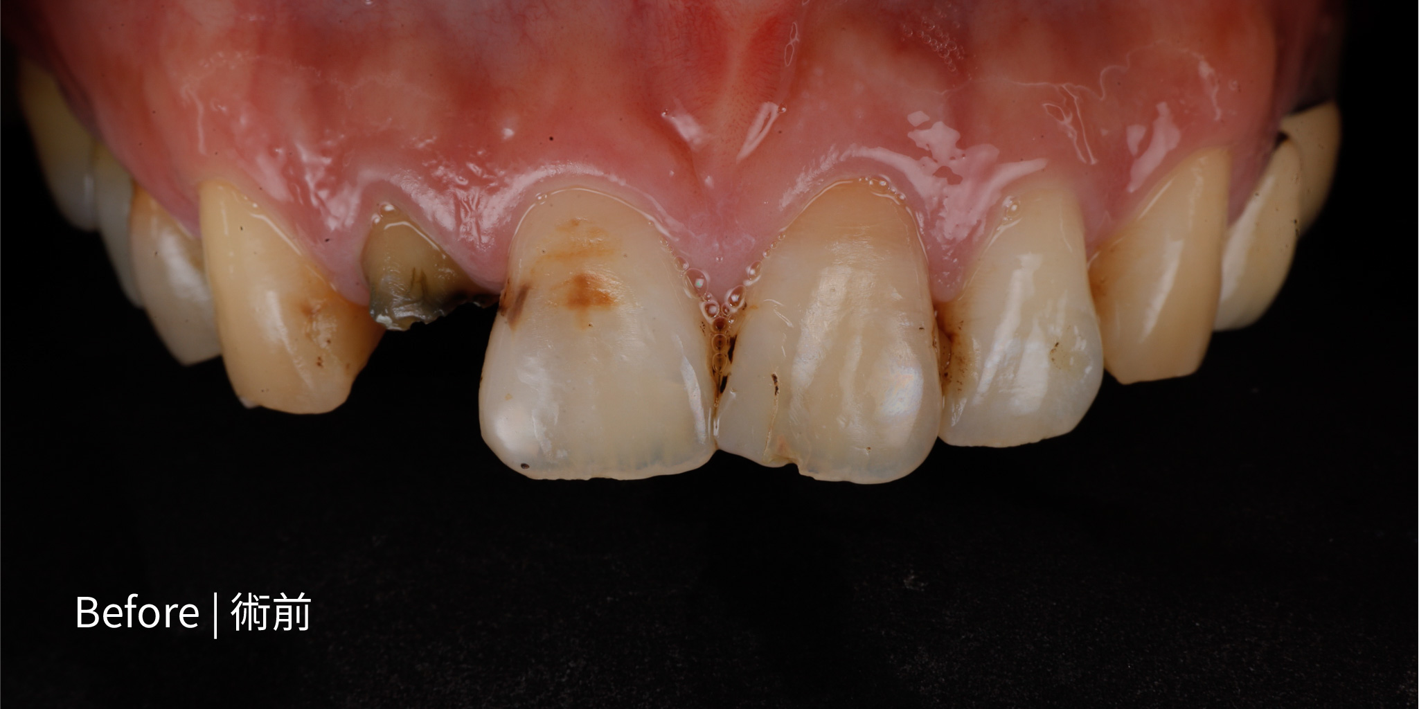 全瓷貼片術前_林佑宸醫師案例