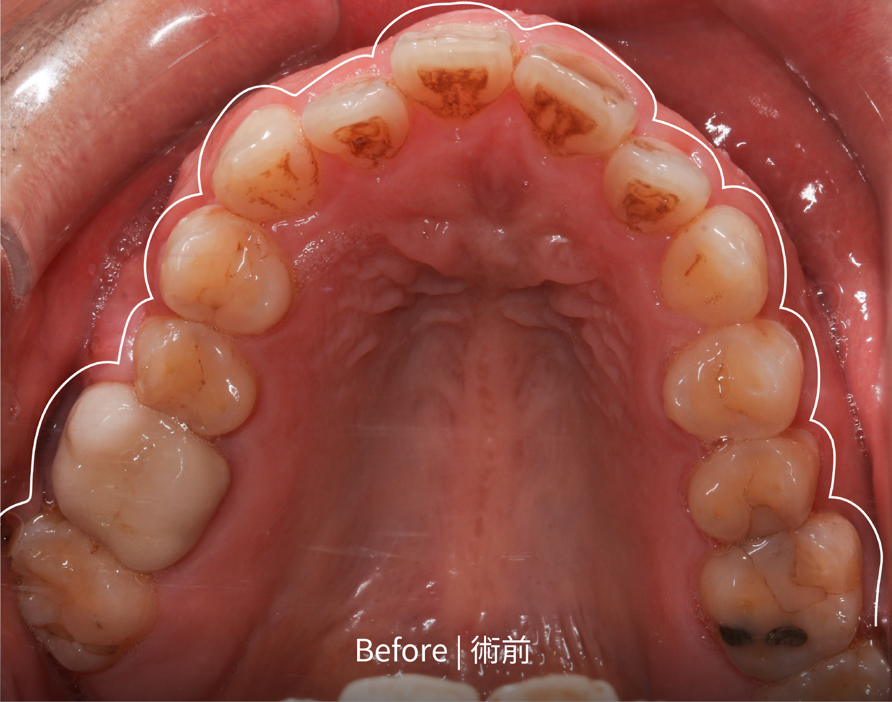 術前上排齒列凌亂透過全瓷貼片調整