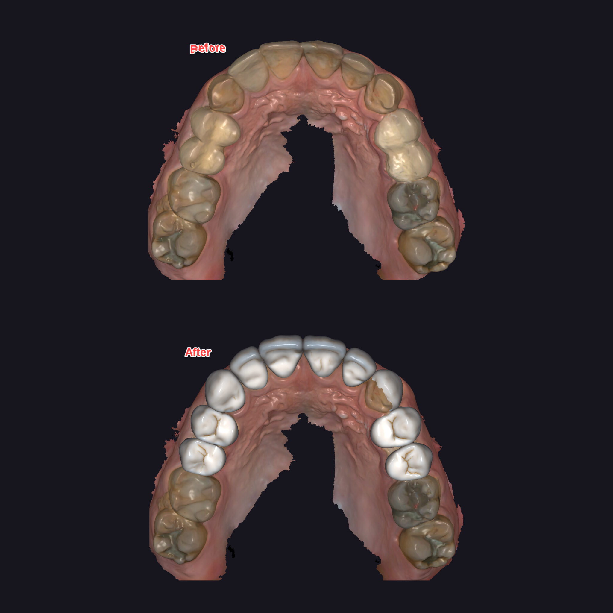 DSD數位微笑設計Digital smile design預先設計建立咬合高度