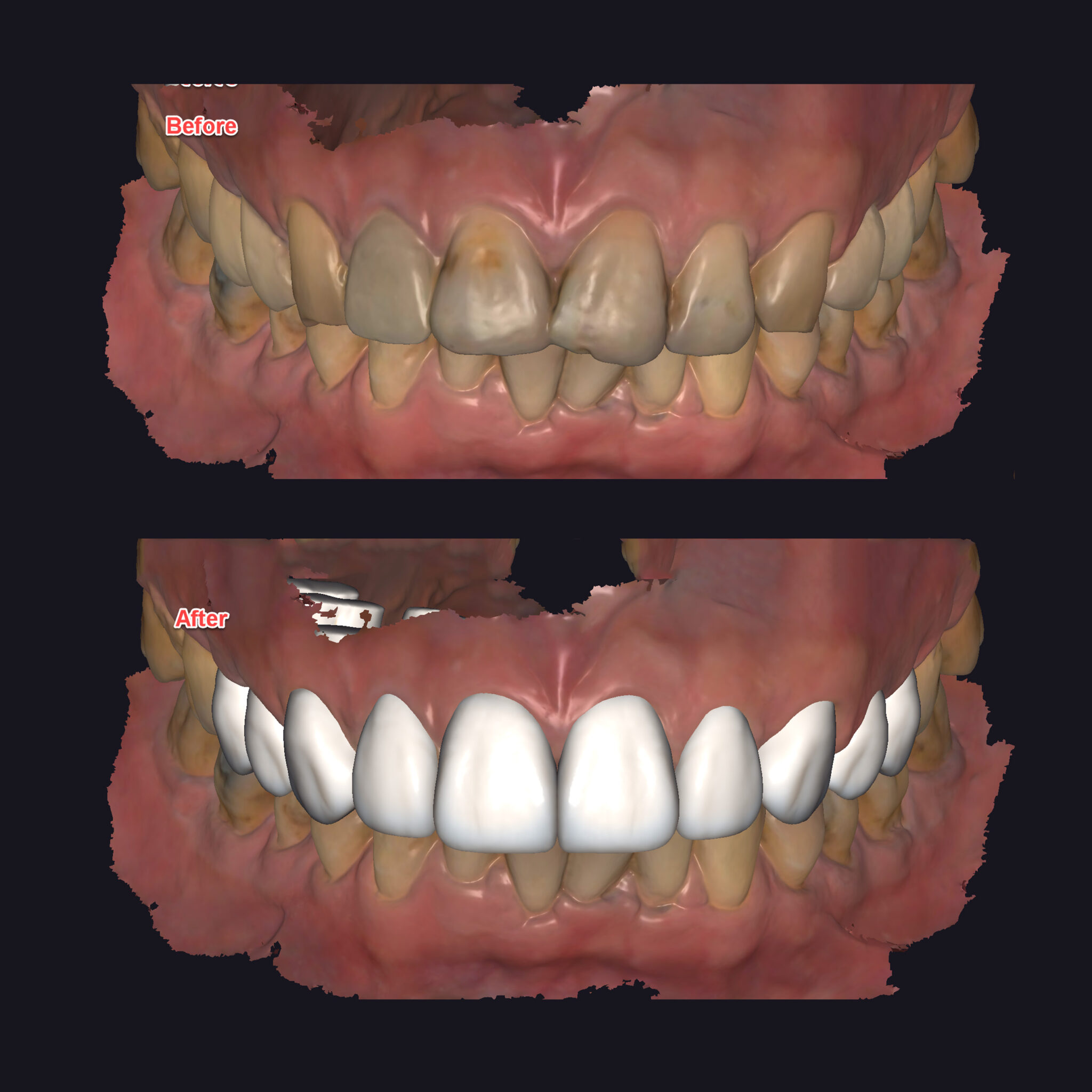 DSD數位微笑設計Digital smile design高度擬真預覽術後笑容