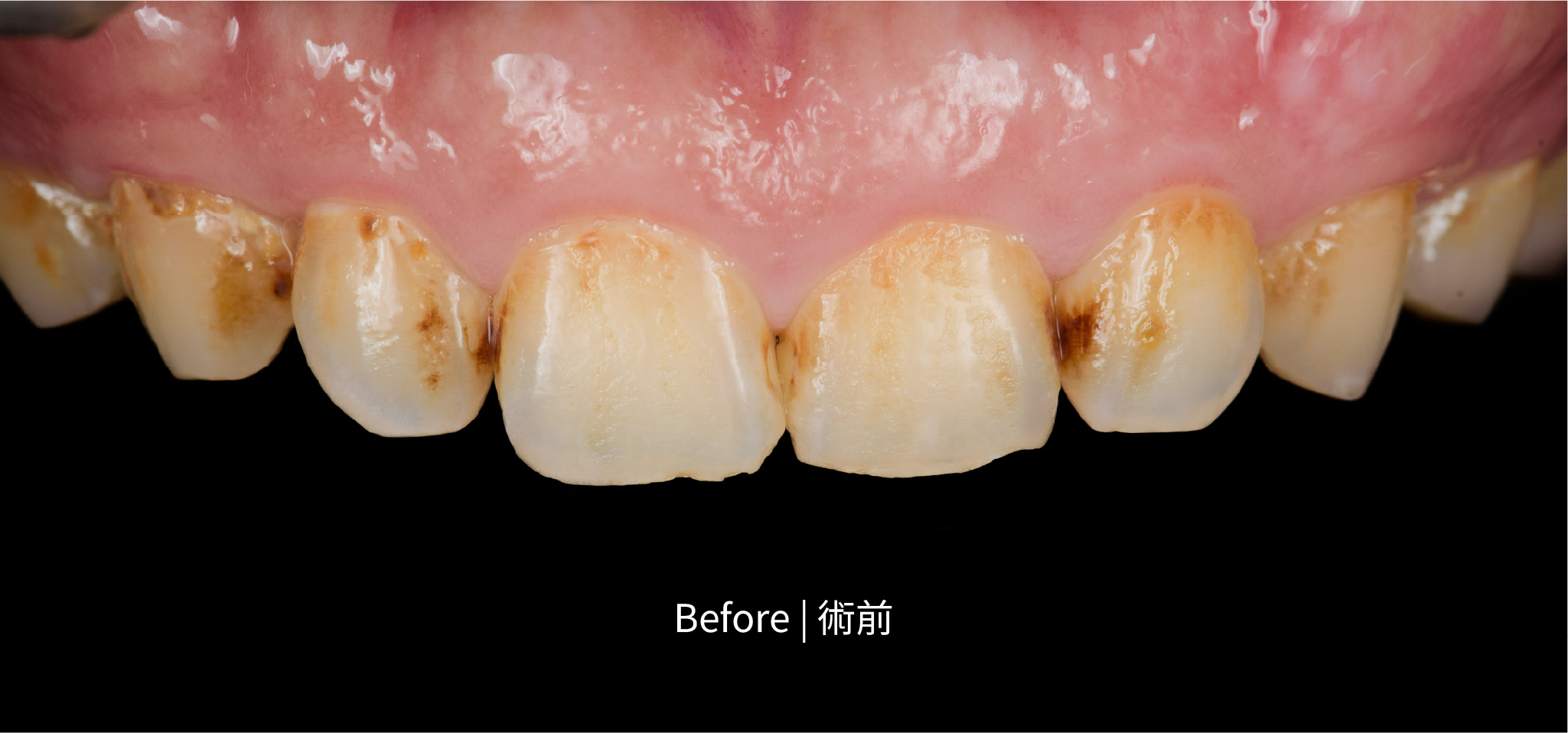 全瓷案例-謝適鴻-術前口內