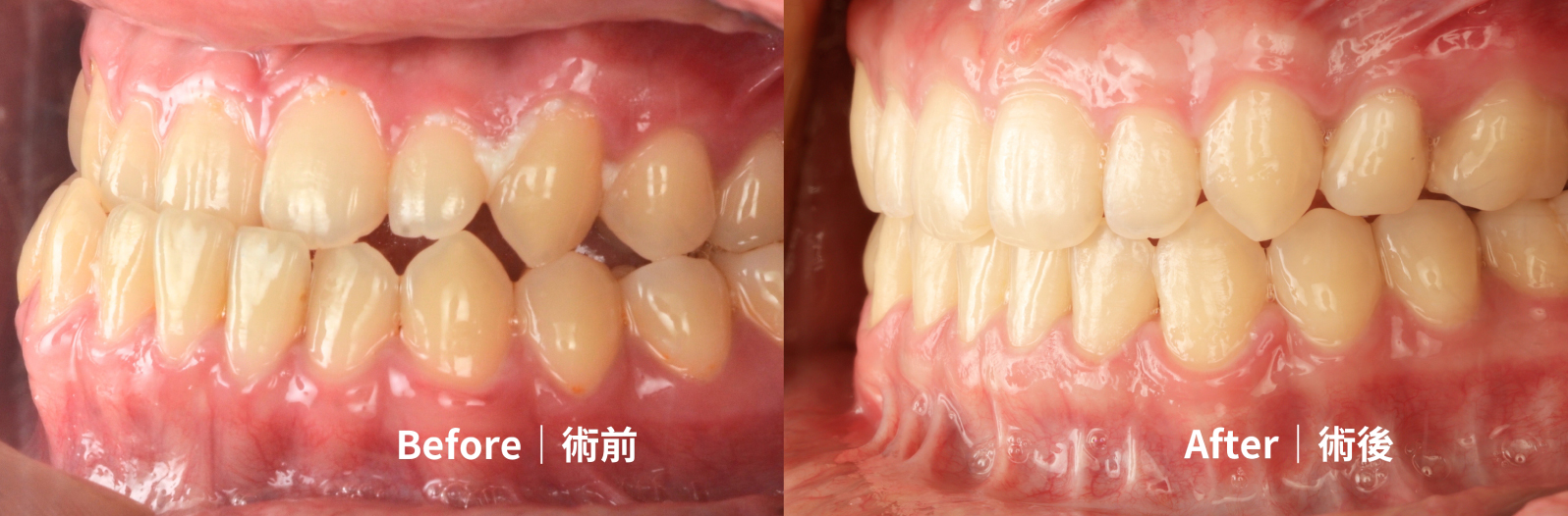 隱適美頁面患者BA半臉照版型-葉秉庭-2